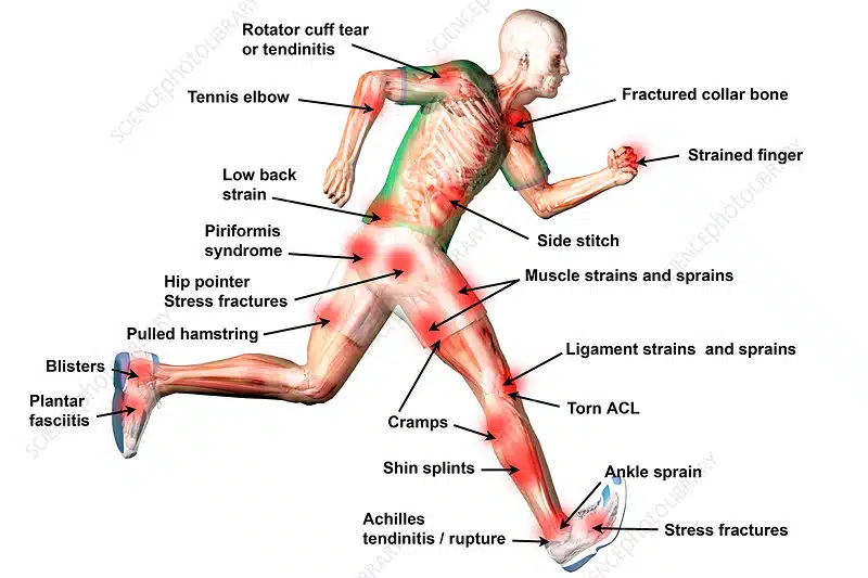 Common Sports Injury Locations Was sind typische Sportverletzungen
