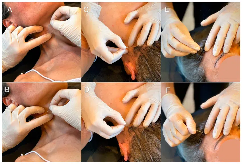 Was ist Dry Needling Was ist Dry Needling?